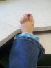 SprainedAnkle.jpg SprainedAnkle.jpg